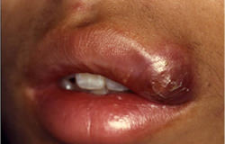口腔～顔面の炎症の病気