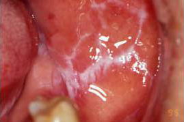 口腔の粘膜の病気